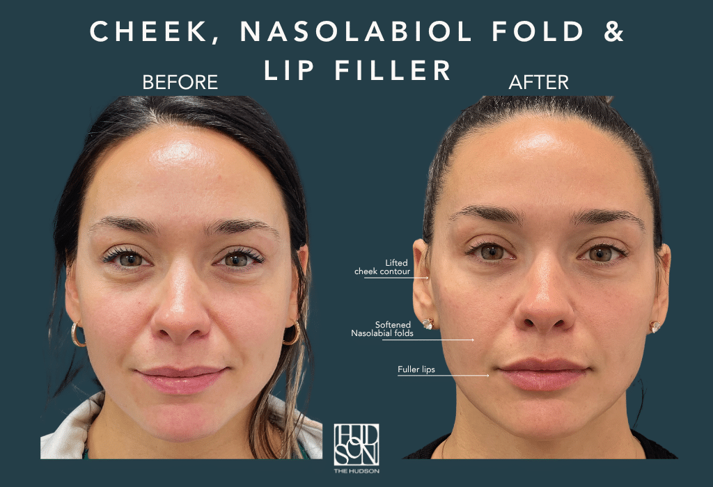 Cheek, Nasolabiol Fold and Lip Filler