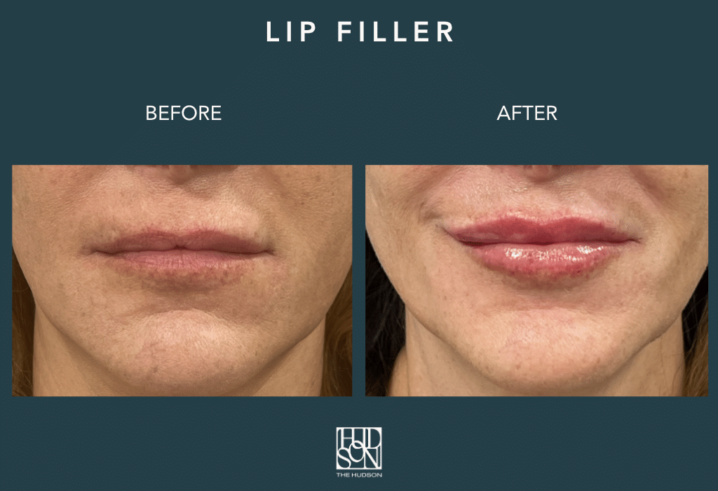 Lip Filler