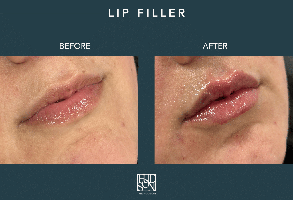 Lip Filler