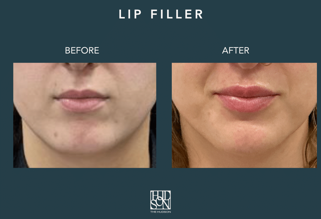 Lip Filler
