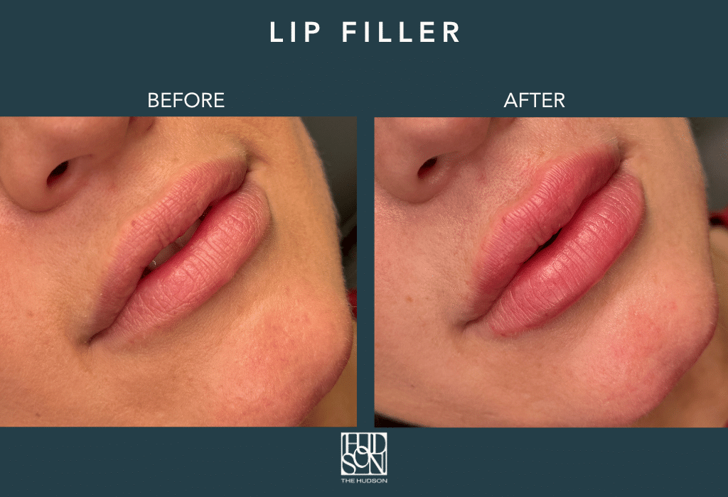 Lip Filler
