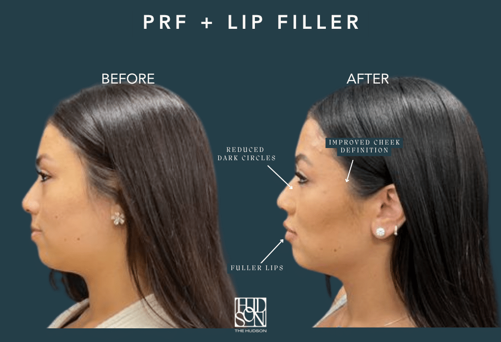 PRF + Lip Filler