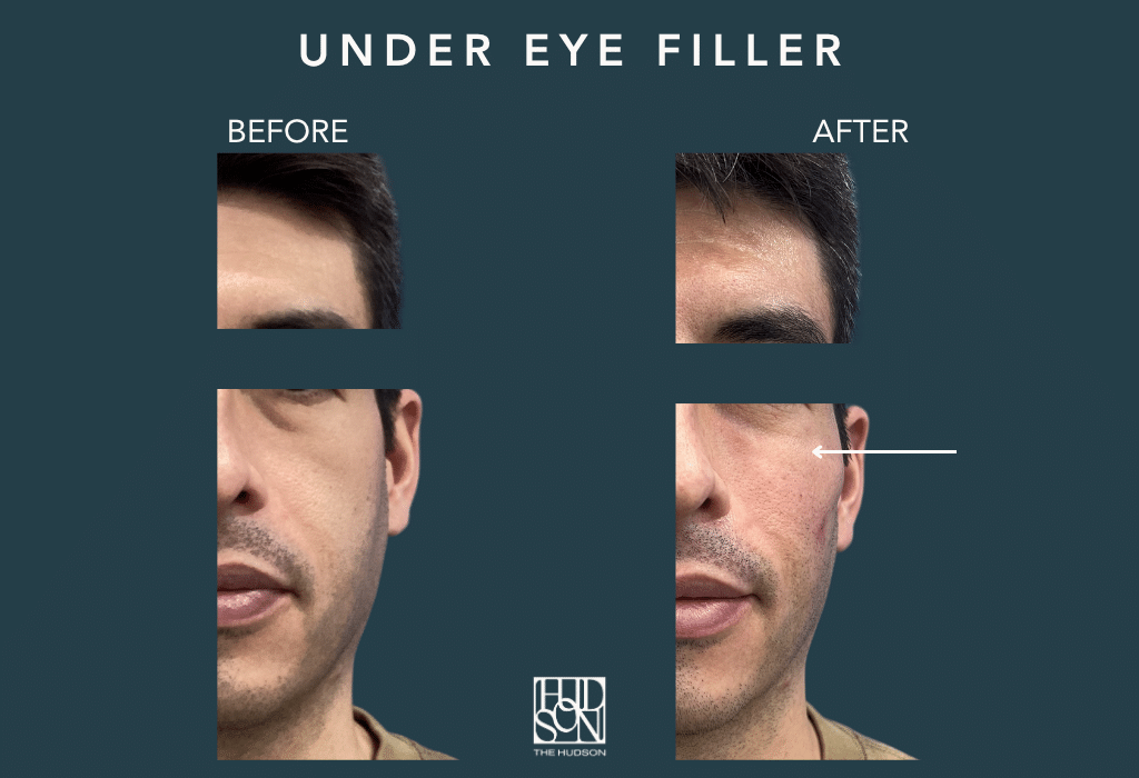 Under Eye Filler