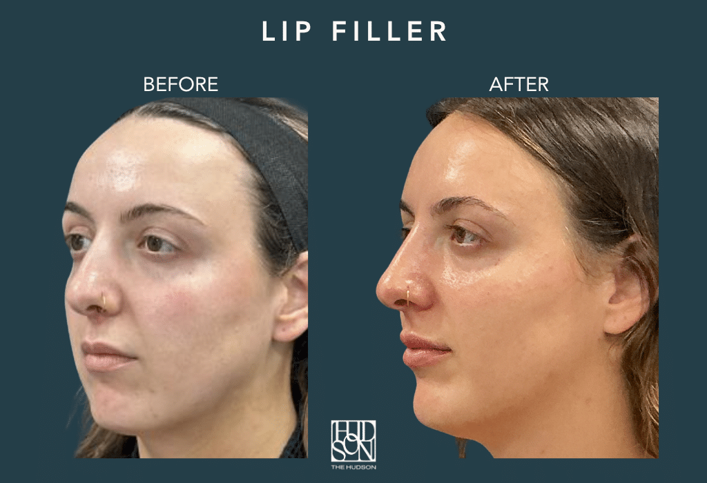 Lip Filler