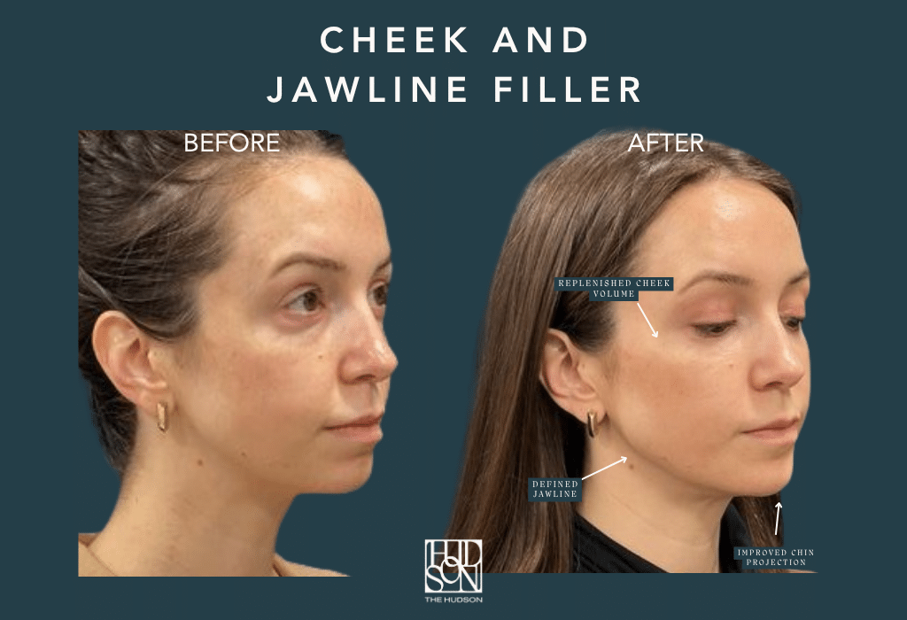 Cheek and Jawline Filler