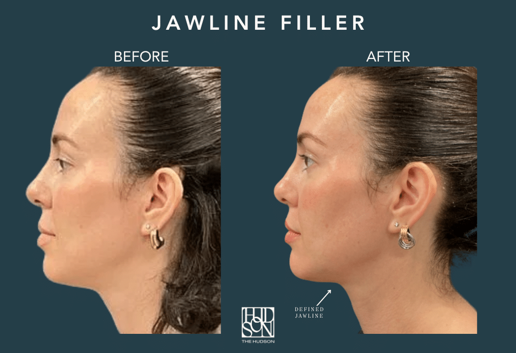 Jawline Filler