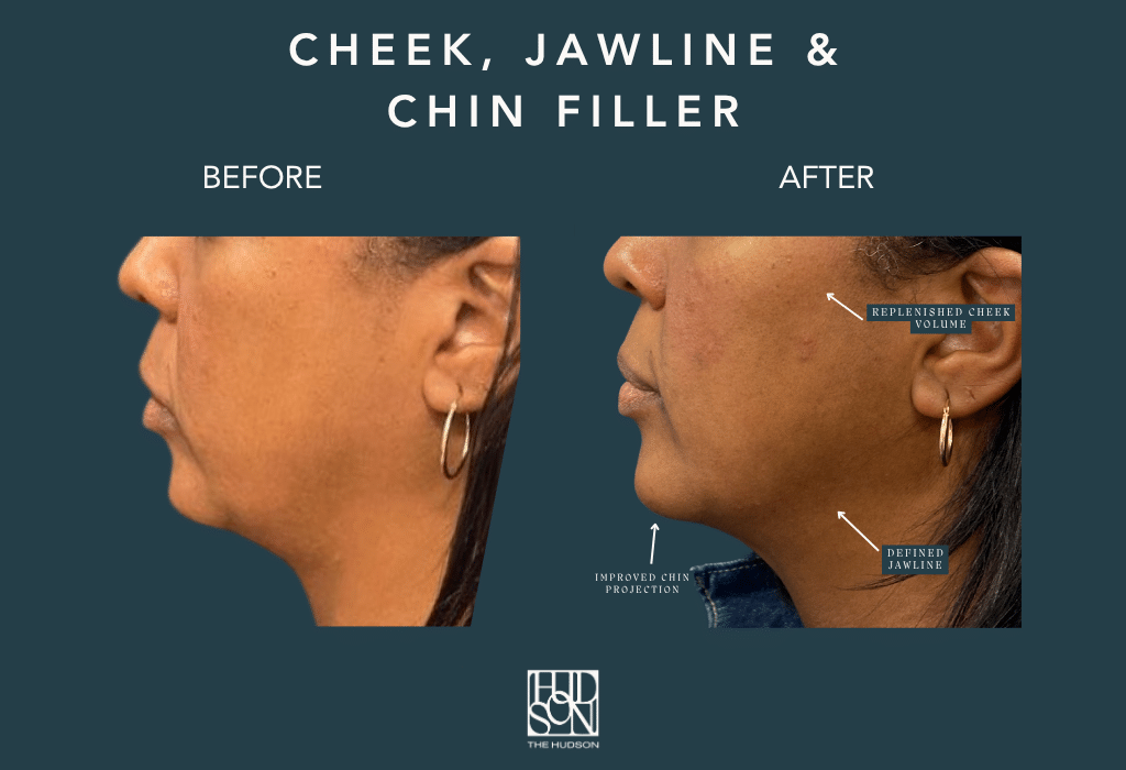 Cheek, Jawline and Chin Filler