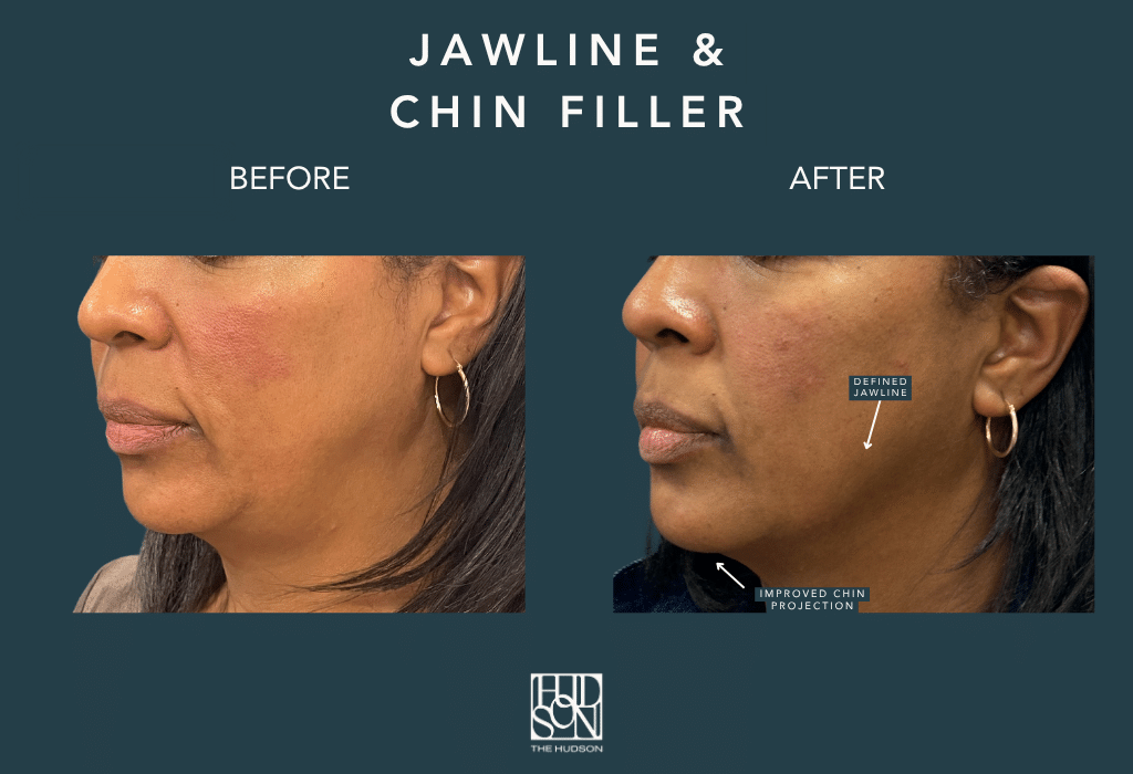 Jawline and Chin Filler