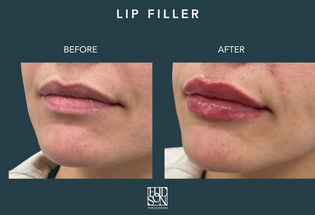 Lip Filler