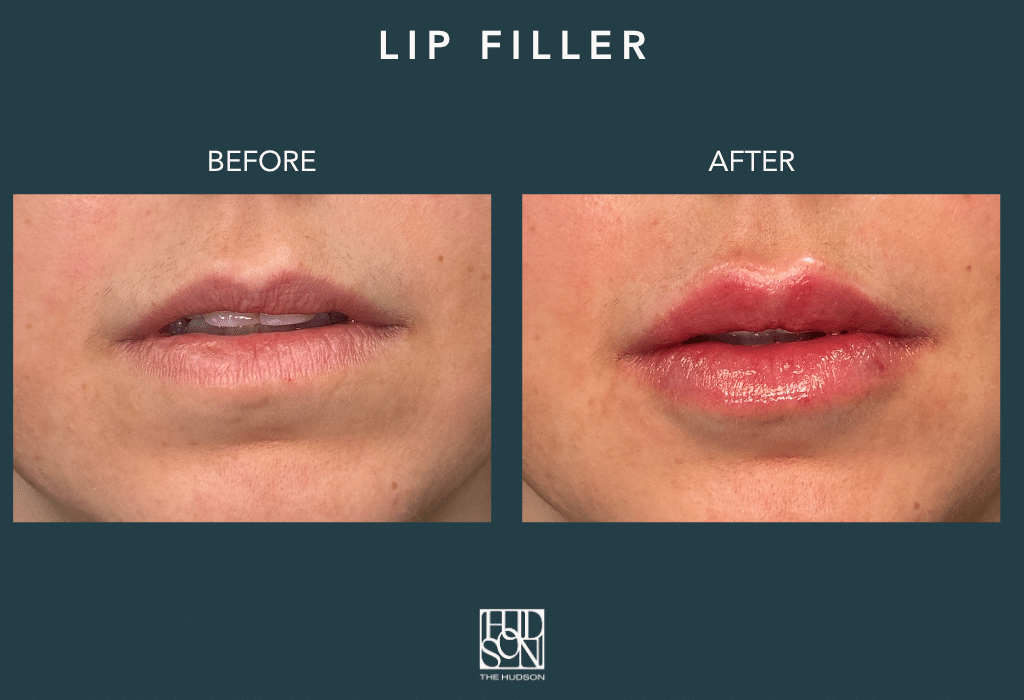 Lip Filler