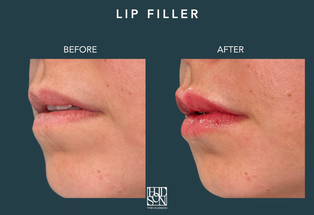 Lip Filler