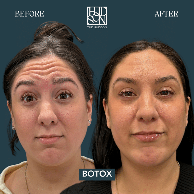 Botox® vs. Dermal Fillers - Botox® – Smooth Away Dynamic Lines